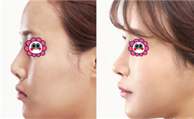 廊坊凱潤(rùn)婷鼻綜合整形案例