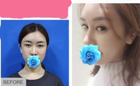 威寧艷冠硅膠假體隆鼻案例