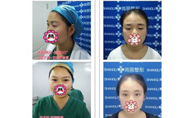 寧波尚麗本院?jiǎn)T工雙眼皮整形案例對(duì)比