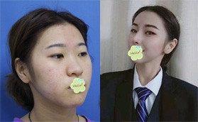 再做膨體肋軟骨隆鼻前,我也超擔心肋骨鼻頭會吸收多少