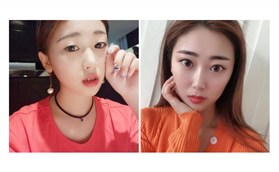 廊坊華康雙眼皮手術案例