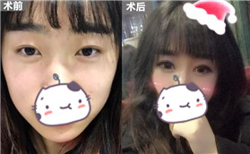 做完全切雙眼皮+開(kāi)內(nèi)眼角手術(shù)后，就是不一樣了