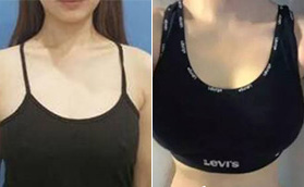 海南華美醫(yī)學(xué)美容醫(yī)院找王武院長(zhǎng)做了假體隆胸，效果明顯