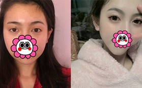 太原華美眼綜合前后對(duì)比案例