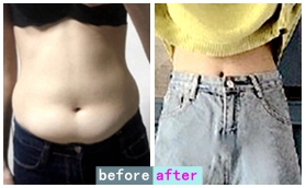 沈陽(yáng)匯美人腰腹部吸脂案例