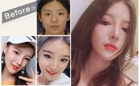 南京藝星BSK宮廷隆鼻案例