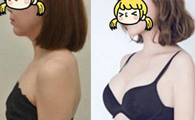 在海南瑞韓做的進口曼托假體隆胸手術，看看效果怎么樣