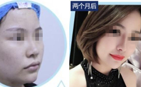 太原時(shí)光自體軟骨隆鼻對(duì)比案例