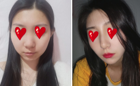 我還在上大學(xué)的時候攢錢去貴陽美貝爾做的假體隆鼻手術(shù)