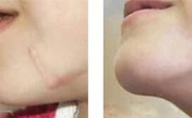 在海南東湖整形做RDL深層再生祛疤術(shù)之祛疤，案例對比明顯