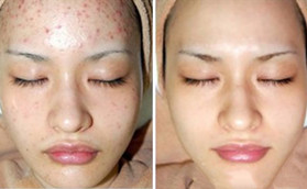 金華亞美整形祛痘案例前后對(duì)比效果
