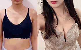 胸小不敢穿吊帶，羨慕胸大的女生，假體隆胸我來(lái)了！