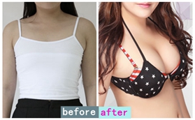 沈陽百嘉麗李衍江黃金定制動(dòng)感美胸案例