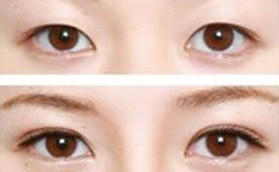 金華心藝整形雙眼皮整形前后對(duì)比效果