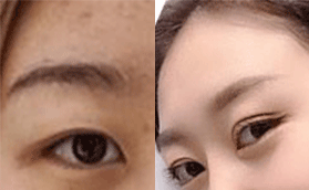 ?？诩t妝尚劉志坤醫(yī)生芭比眼綜合手術(shù)的優(yōu)勢以及案例分享