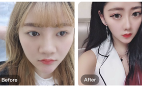 南京華美美容醫(yī)院沈正宇肋軟骨鼻綜合案例