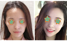 在哈爾濱諾依美做自體脂肪填充面部3個月后給出恢復照片