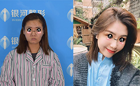 廈門銀河整形做了自體脂肪全臉填充恢復(fù)后效果也太好了吧