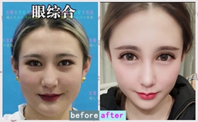 沈陽童顏醫(yī)療美容李夢(mèng)穎院長阿拉蕾網(wǎng)紅大眼案例