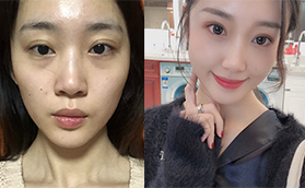 青島華韓整形美容醫(yī)院面部脂肪填充案例