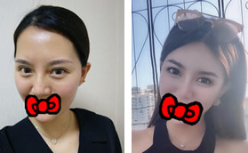 花18000元找鄭州張朝蕾整形做自體脂肪全臉填充后顯年輕好多