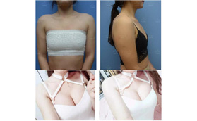 FDA+CE雙重認(rèn)證的傲諾拉閃耀假體，這手感10萬的價(jià)格也認(rèn)了