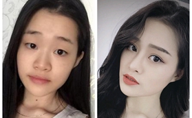 株洲華美全切雙眼皮+鼻綜合真人案例