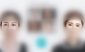 岳陽愛思特醫(yī)療美容靈韻大眼雙眼皮術案例