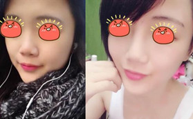 金華金東區(qū)令顏醫(yī)療美容門診部玻尿酸隆鼻前后對(duì)比