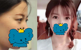 桂林哪里割雙眼皮比較好?桂林時光張華峰雙眼皮必須上榜