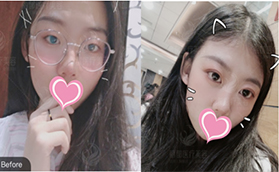 北京米蘭柏羽麗都曹衛(wèi)華做雙眼皮效果怎么樣？埋線雙眼皮真人案例