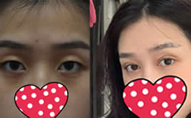 真人案例:小姐姐找重慶好美李曾顯做開扇形雙眼皮7mm效果圖