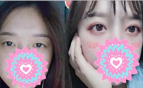 秦皇島念奴嬌割雙眼皮好嗎?來看全切雙眼皮恢復過程圖