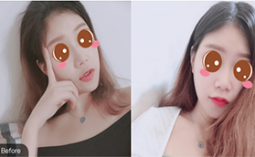 北京豐唇哪家好？記錄在北京葉子玻尿酸豐唇十天恢復(fù)情況