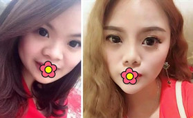 金華永康光大醫(yī)療美容隆鼻+雙眼皮前后對比效果