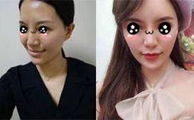 快看我沒花多錢在廈門儷人整形做的自體脂肪面部填充效果