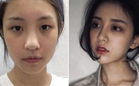 找蘭州皙妍麗醫(yī)療馬振峰醫(yī)生做完鼻部多項(xiàng)后顏值飆升！