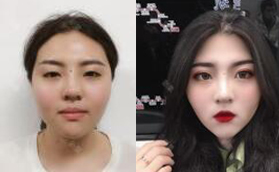 蘭州夢想整形醫(yī)院趙梅霞雙眼皮怎么樣？價格案例大曝光！