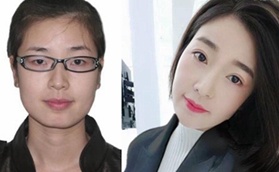 株洲宇芳姬醫(yī)療美容明眸翹睫美眼綜合改善案例