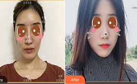 都說(shuō)喬愛(ài)軍脂肪填充收費(fèi)高在北京京韓做VST藝術(shù)面雕覺(jué)得值