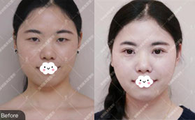 誰說深圳瑞芙臣割雙眼皮價格貴，我做后感覺性價比蠻高的