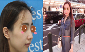 北京去斑需要多錢？北京藝星蜂巢皮秒去斑真人案例供參考