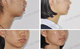 廣州圣貝口腔深覆蓋牙齒矯正案例前后對比照