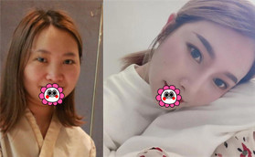 昆明藝星金輝擅長做鼻修復(fù)找他做肋軟骨隆鼻恢復(fù)后果然美