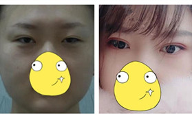 雙眼皮修復我找的是在哈爾濱星璨坐診的王潔醫(yī)生,理由如下