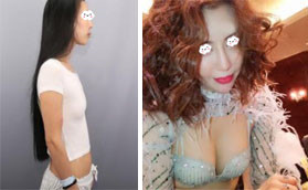 深圳陽光是正規(guī)醫(yī)院，在這做的傲諾拉假體隆胸性價(jià)比很高