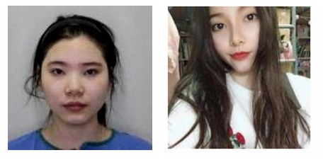 南京米尚恩醫(yī)療美容黃發(fā)自然美學鼻綜合案例