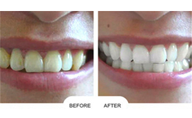 青島優(yōu)諾博士口腔醫(yī)院張洪敏超聲波潔牙案例