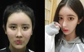 我面部脂肪填充過(guò)量失敗去鄭荃麗格做抽吸修復(fù)才恢復(fù)原貌