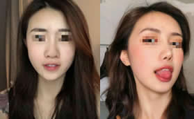 我在重慶yestar藝星做半肋骨隆鼻60天,朋友都說太自然了